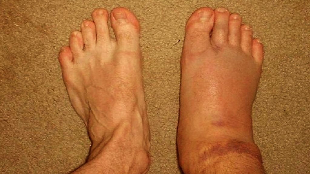 the-5-best-natural-remedies-for-swollen-ankles-legs-and-feet